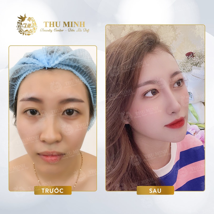 nâng chân mũi xệ